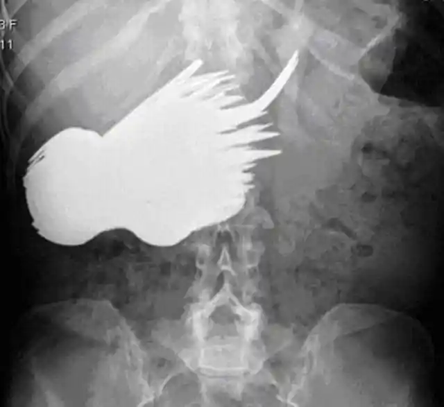 15 Mind Boggling X-Ray Photos That Will Make You Thankful You’re NOT A Doctor